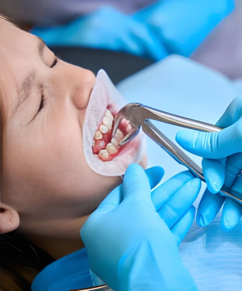 Emergency Tooth Extractions home Emergency Tooth Extractions home