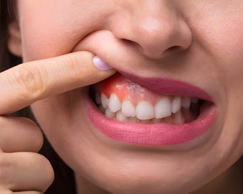 Dental Infection Or Swelling- home Dental Infection Or Swelling- home