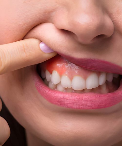 Dental Infection Or Swelling- home Dental Infection Or Swelling- home
