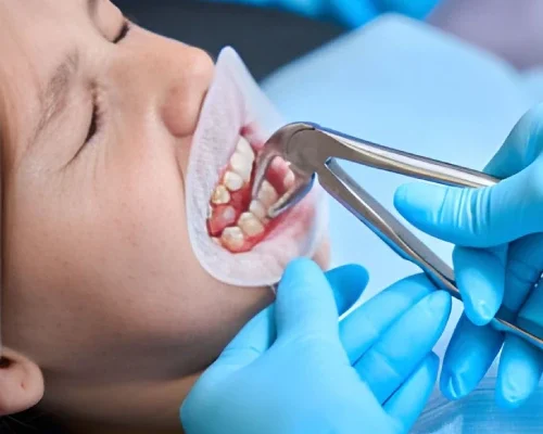 Emergency Tooth Extractions home Emergency Tooth Extractions home