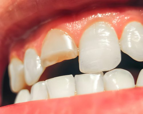 knocked out teeth home knocked out teeth home