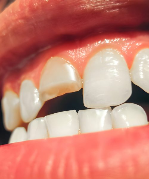 knocked out teeth home knocked out teeth home